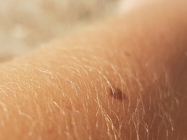 ניתוח מוס לנגעים בעור ונקודות חן – מה זה בעצם ואיך מונעים התפשטות סרטן העור?